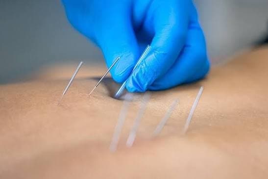 Acupuncture and Cupping Therapy