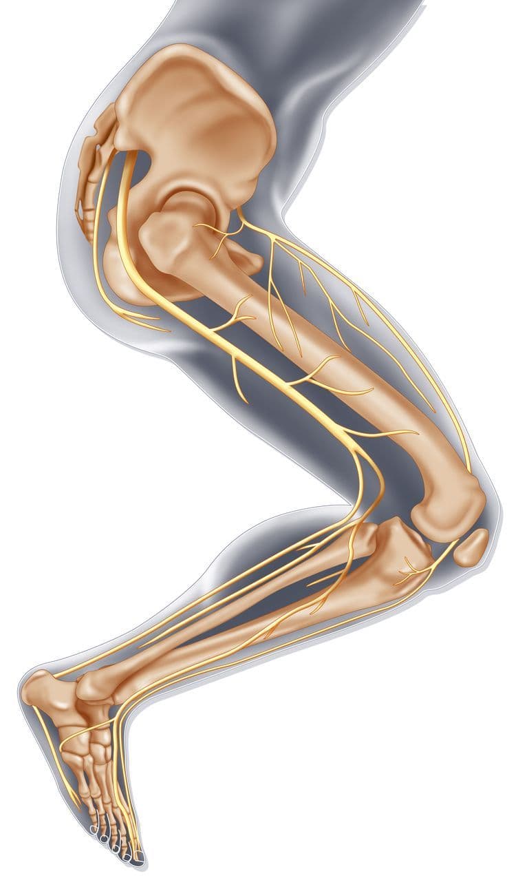 Piriformis syndrome
