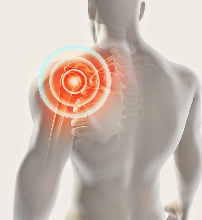 Rotator cuff pain